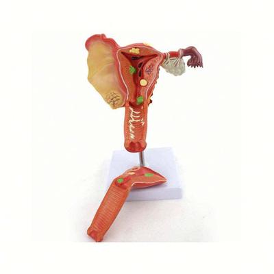 Pathological Uterus Ovary Model