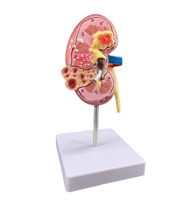 Diseased Kidney Anatomy Model