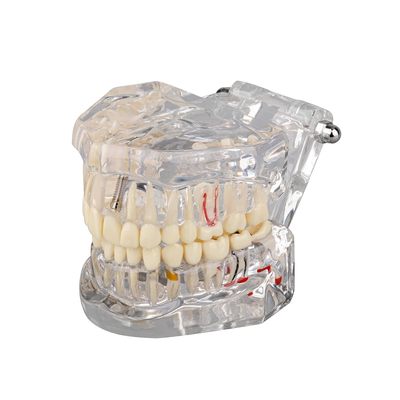 Transparent Disease Teeth Model