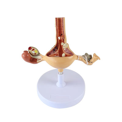 Pathological Uterine Model