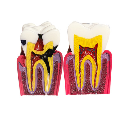 6 Times Caries Bilateral Comparison Pathology Model