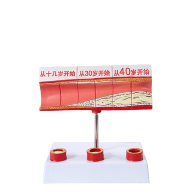 7-Stage Atherosclerosis Vascular Model
