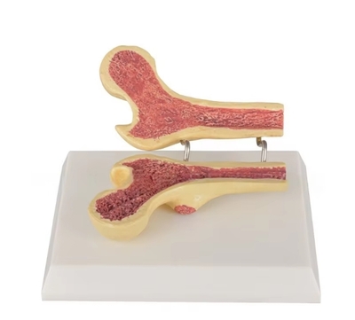 Two Femur Osteoporosis Pathology and Healthy Bone Density Comparison