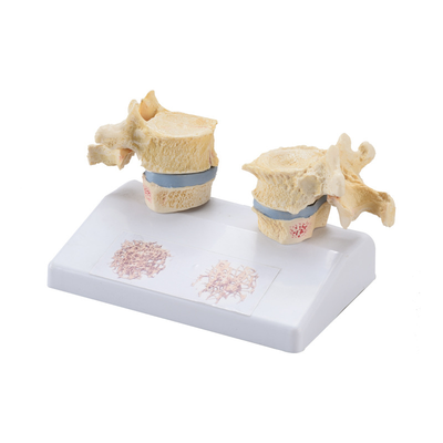 Human bone osteoporosis model